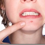 acne visage thumb 150x150 Remedes 100% naturels pour combattre lAcn&eacute;