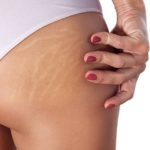 Éliminer la Cellulite Naturellement