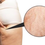 Démystifiez les causes de la cellulite et adoptez une approche informée pour une peau lisse et tonifiée.